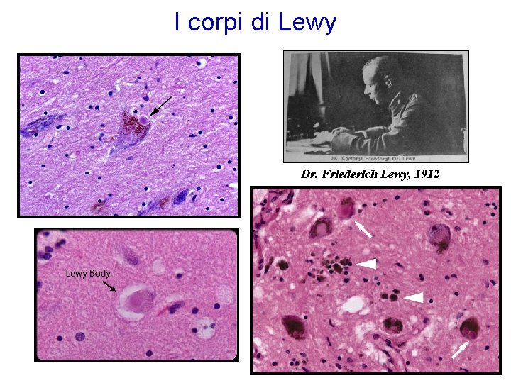 I corpi di Lewy Dr. Friederich Lewy, 1912 I corpi di Lewy Dr. Friederich Lewy, 1912