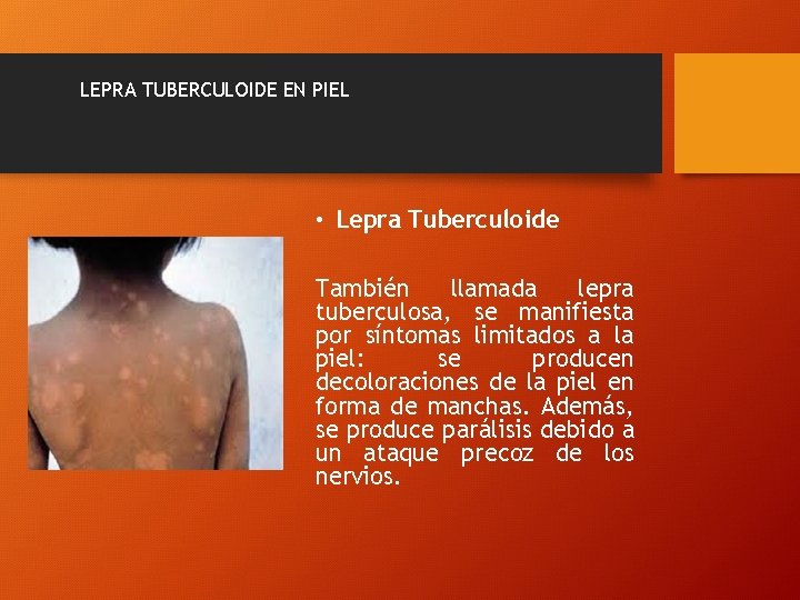 LEPRA TUBERCULOIDE EN PIEL • Lepra Tuberculoide También llamada lepra tuberculosa, se manifiesta por