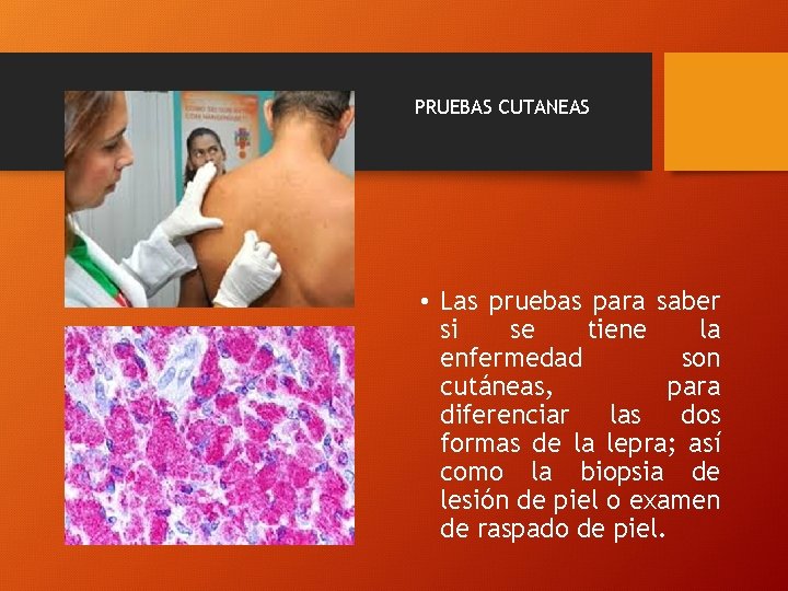 PRUEBAS CUTANEAS • Las pruebas para saber si se tiene la enfermedad son cutáneas,