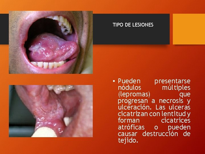 TIPO DE LESIONES • Pueden presentarse nódulos múltiples (lepromas) que progresan a necrosis y