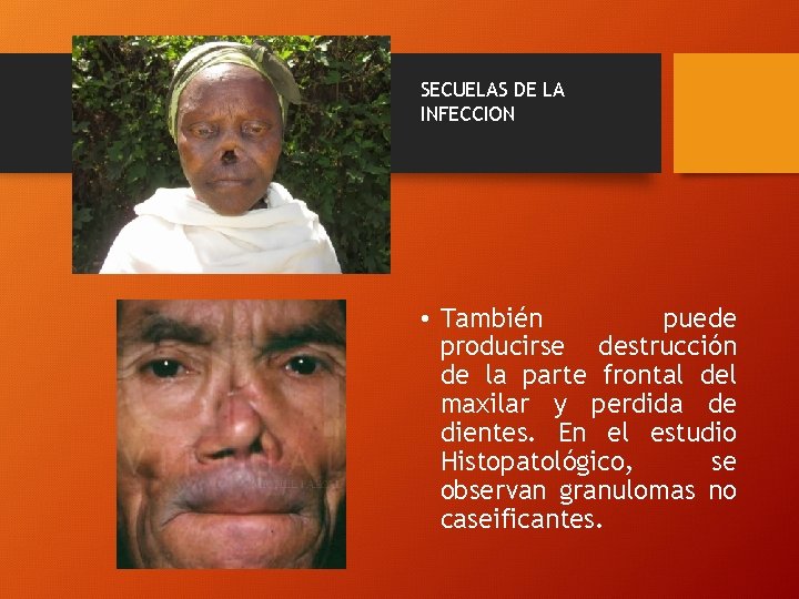 SECUELAS DE LA INFECCION • También puede producirse destrucción de la parte frontal del
