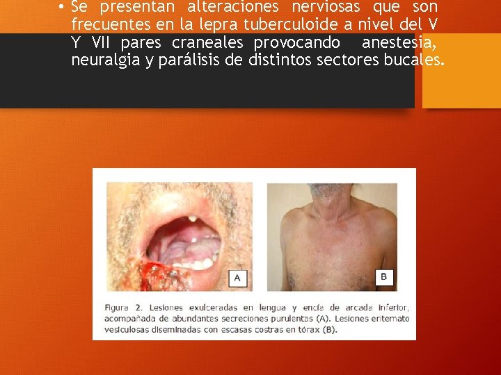  • Se presentan alteraciones nerviosas que son frecuentes en la lepra tuberculoide a