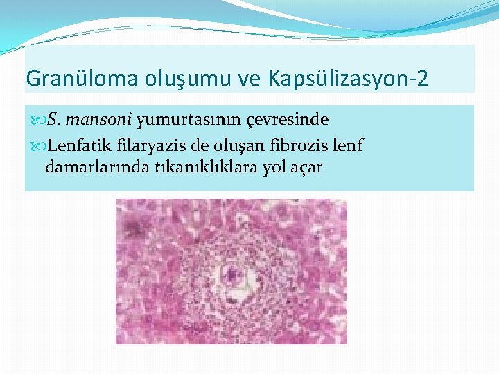 Granüloma oluşumu ve Kapsülizasyon-2 S. mansoni yumurtasının çevresinde Lenfatik filaryazis de oluşan fibrozis lenf