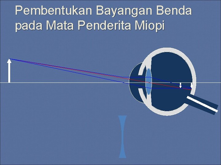 Pembentukan Bayangan Benda pada Mata Penderita Miopi Pembentukan Bayangan Benda pada Mata Penderita Miopi