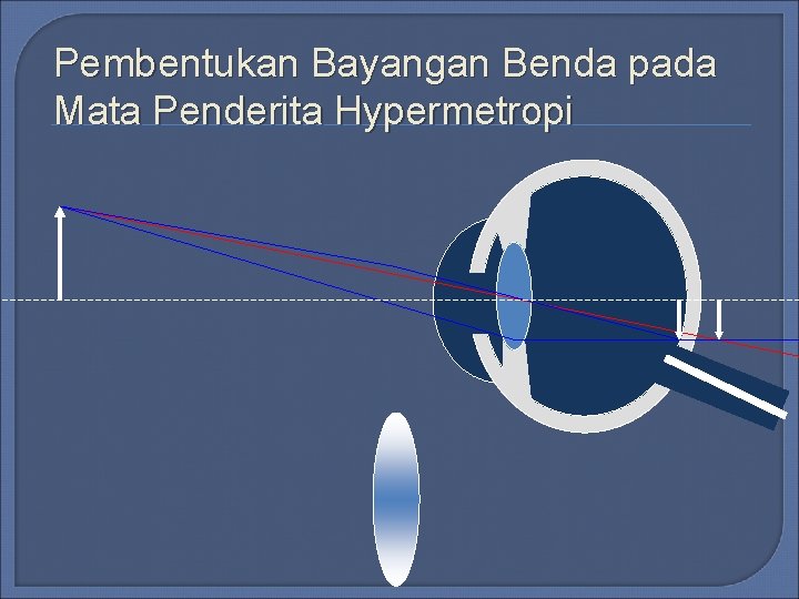 Pembentukan Bayangan Benda pada Mata Penderita Hypermetropi Pembentukan Bayangan Benda pada Mata Penderita Hypermetropi