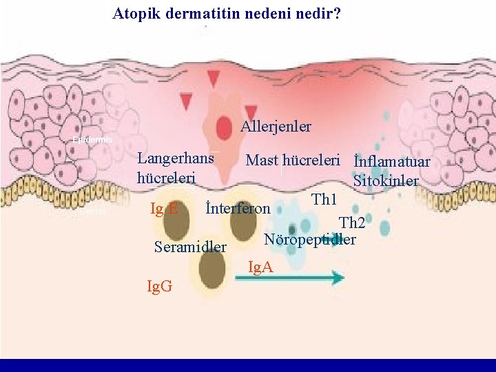 Atopik dermatitin nedeni nedir? Allerjenler Epidermis Langerhans hücreleri Dermis Mast hücreleri İnflamatuar Sitokinler Th Atopik dermatitin nedeni nedir? Allerjenler Epidermis Langerhans hücreleri Dermis Mast hücreleri İnflamatuar Sitokinler Th