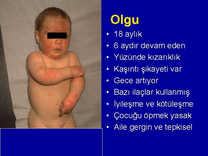Olgu • • • 18 aylık 6 aydır devam eden Yüzünde kızarıklık Kaşıntı şikayeti Olgu • • • 18 aylık 6 aydır devam eden Yüzünde kızarıklık Kaşıntı şikayeti