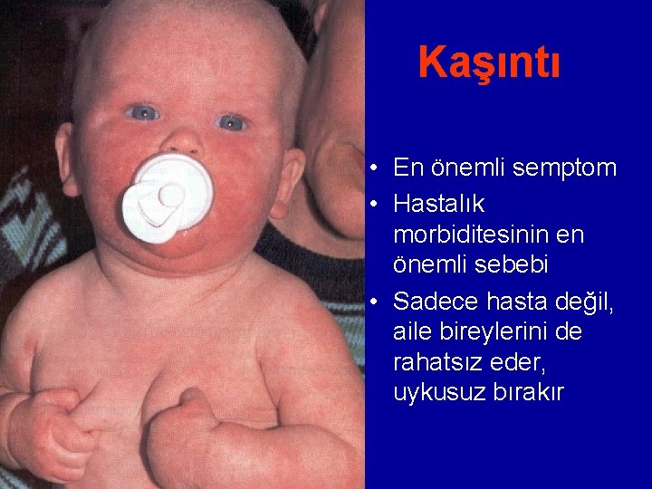 Kaşıntı • En önemli semptom • Hastalık morbiditesinin en önemli sebebi • Sadece hasta Kaşıntı • En önemli semptom • Hastalık morbiditesinin en önemli sebebi • Sadece hasta