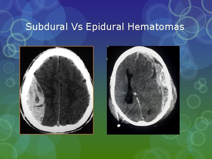 Subdural Vs Epidural Hematomas Subdural Vs Epidural Hematomas