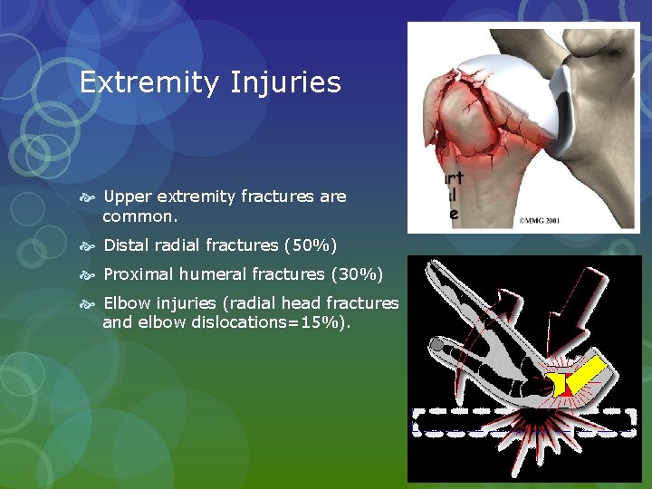 Extremity Injuries Upper extremity fractures are common. Distal radial fractures (50%) Proximal humeral fractures Extremity Injuries Upper extremity fractures are common. Distal radial fractures (50%) Proximal humeral fractures