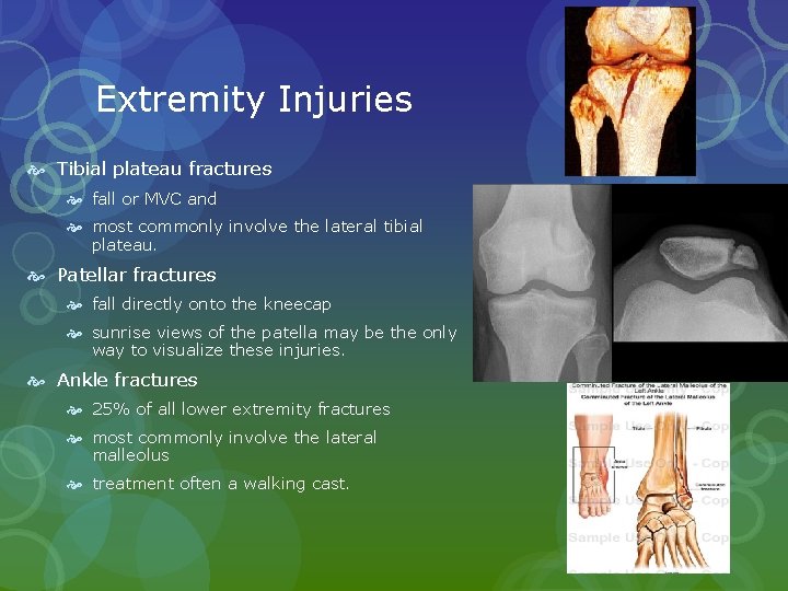 Extremity Injuries Tibial plateau fractures fall or MVC and most commonly involve the lateral Extremity Injuries Tibial plateau fractures fall or MVC and most commonly involve the lateral