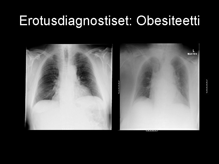 Erotusdiagnostiset: Obesiteetti 