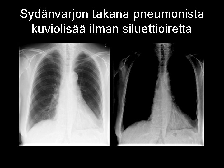 Sydänvarjon takana pneumonista kuviolisää ilman siluettioiretta 