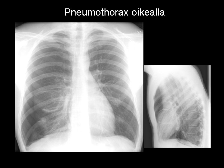 Pneumothorax oikealla Ilmarinta oikealla 