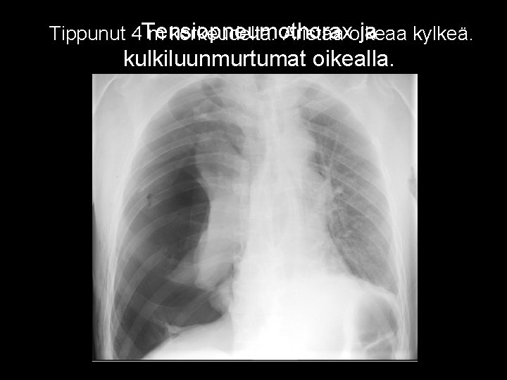 ja Tippunut 4 Tensiopneumothorax m Jänniteilmarinta korkeudelta. Aristaa oikeaa kylkeä. kulkiluunmurtumat oikealla. 