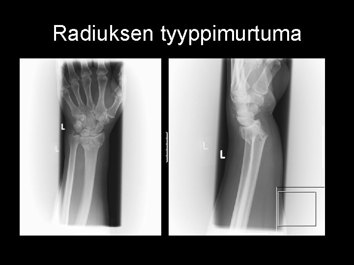 Radiuksen tyyppimurtuma 