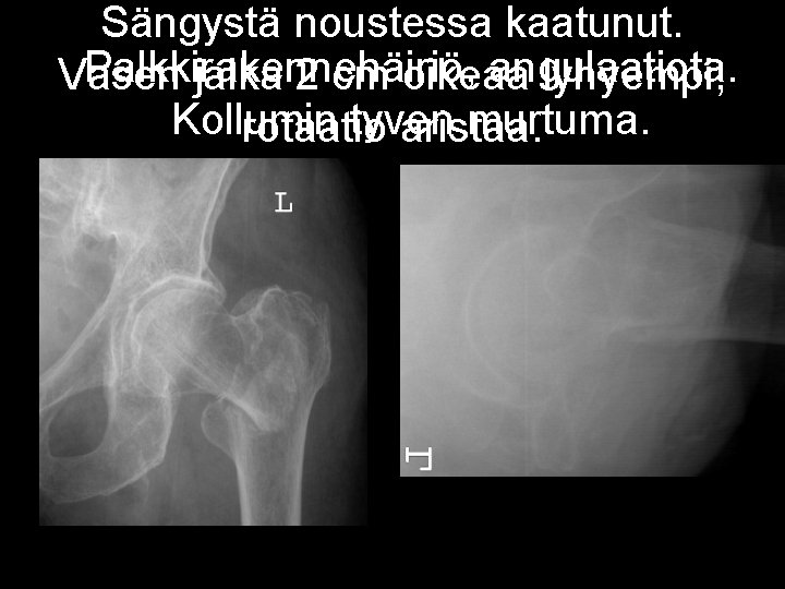 Sängystä noustessa kaatunut. Palkkirakennehäiriö, angulaatiota. Vasen jalka 2 cm oikeaa lyhyempi, Kollumin tyven murtuma.