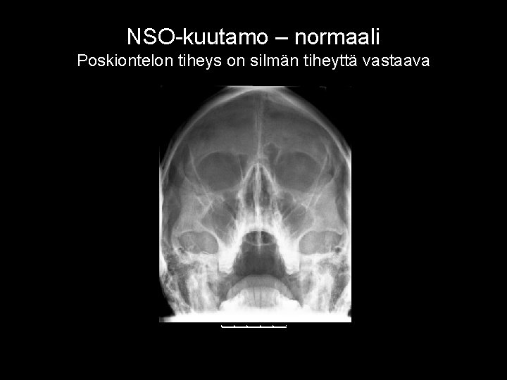 NSO-kuutamo – normaali Poskiontelon tiheys on silmän tiheyttä vastaava 