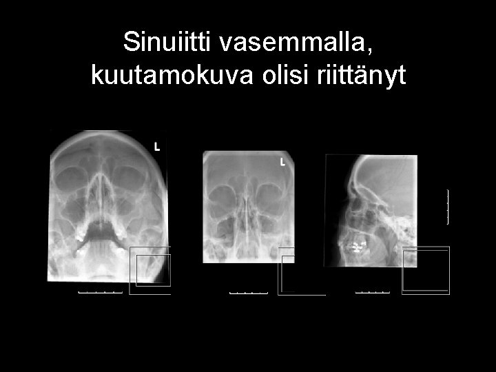 Sinuiitti vasemmalla, kuutamokuva olisi riittänyt 