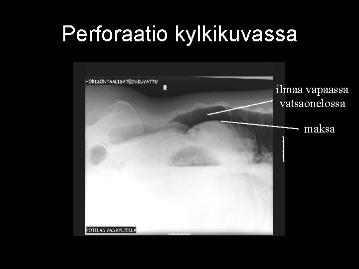 Perforaatio kylkikuvassa ilmaa vapaassa vatsaonelossa maksa 