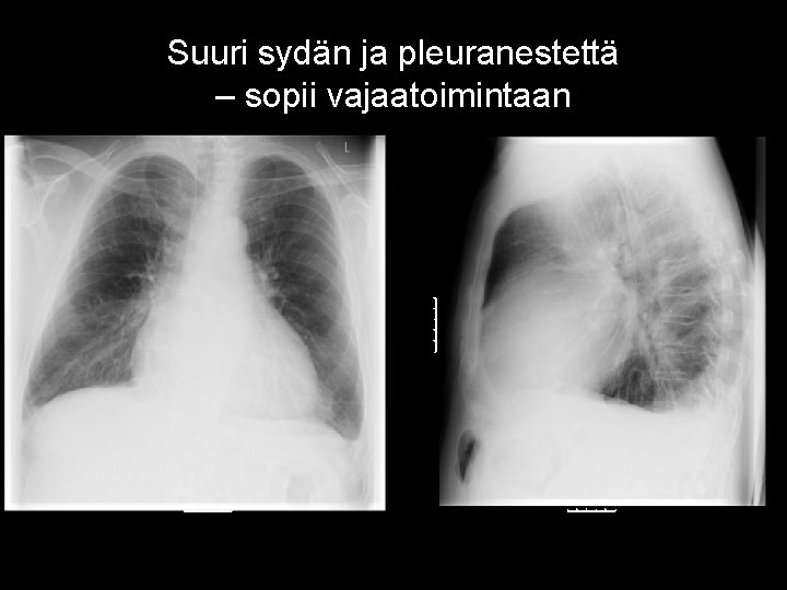 Suuri sydän ja pleuranestettä – sopii vajaatoimintaan 