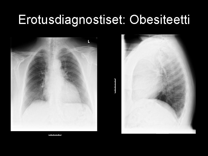 Erotusdiagnostiset: Obesiteetti 