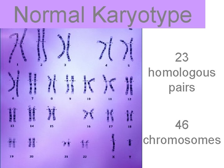 Normal Karyotype 23 homologous pairs 46 chromosomes 