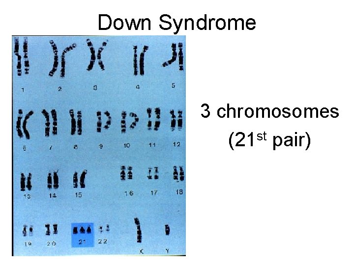Down Syndrome 3 chromosomes (21 st pair) 