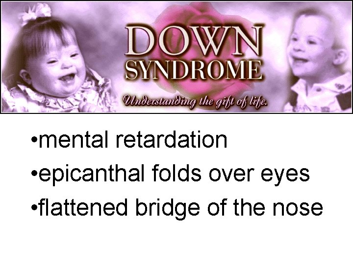 Down Syndrome Traits • mental retardation • epicanthal folds over eyes • flattened bridge