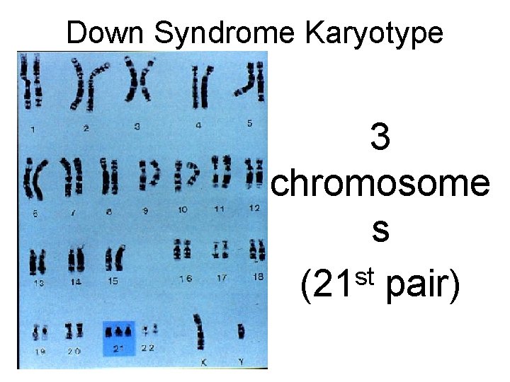 Down Syndrome Karyotype 3 chromosome s st (21 pair) 