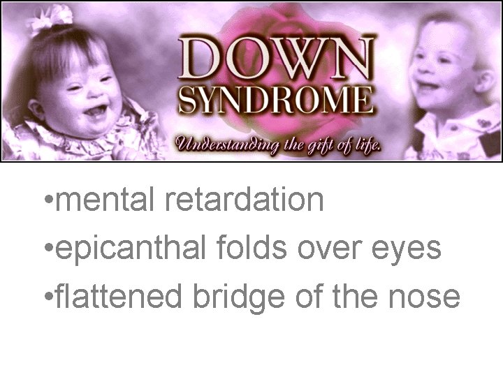 Down Syndrome Traits • mental retardation • epicanthal folds over eyes • flattened bridge