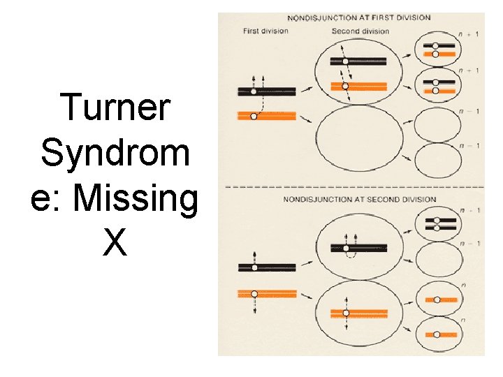 Turner Syndrom e: Missing X 