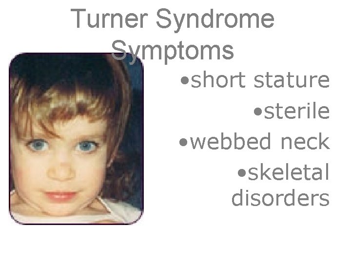 Turner Syndrome Symptoms • short stature • sterile • webbed neck • skeletal disorders