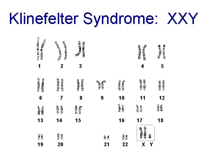 Klinefelter Syndrome: XXY 