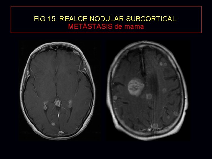 FIG 15. REALCE NODULAR SUBCORTICAL: METÁSTASIS de mama 