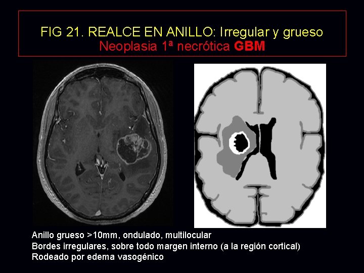 FIG 21. REALCE EN ANILLO: Irregular y grueso Neoplasia 1ª necrótica GBM Anillo grueso