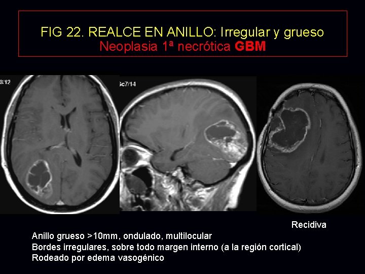 FIG 22. REALCE EN ANILLO: Irregular y grueso Neoplasia 1ª necrótica GBM Recidiva Anillo