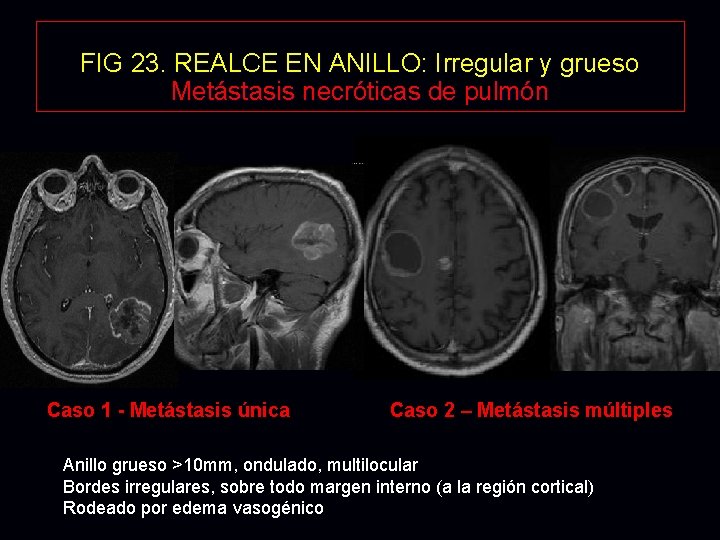 FIG 23. REALCE EN ANILLO: Irregular y grueso Metástasis necróticas de pulmón Caso 1