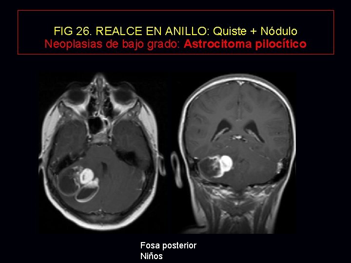 FIG 26. REALCE EN ANILLO: Quiste + Nódulo Neoplasias de bajo grado: Astrocitoma pilocítico