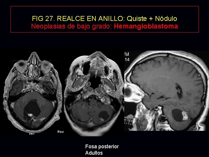 FIG 27. REALCE EN ANILLO: Quiste + Nódulo Neoplasias de bajo grado: Hemangioblastoma Fosa