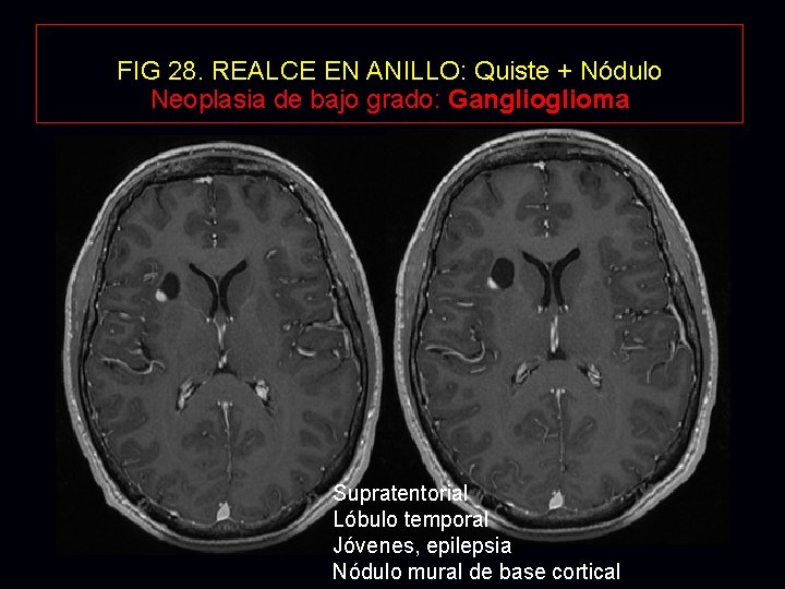 FIG 28. REALCE EN ANILLO: Quiste + Nódulo Neoplasia de bajo grado: Ganglioma Supratentorial