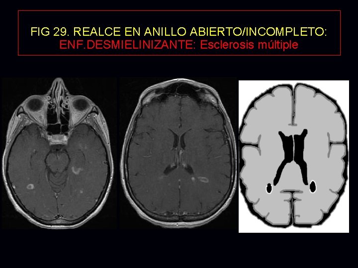 FIG 29. REALCE EN ANILLO ABIERTO/INCOMPLETO: ENF. DESMIELINIZANTE: Esclerosis múltiple 