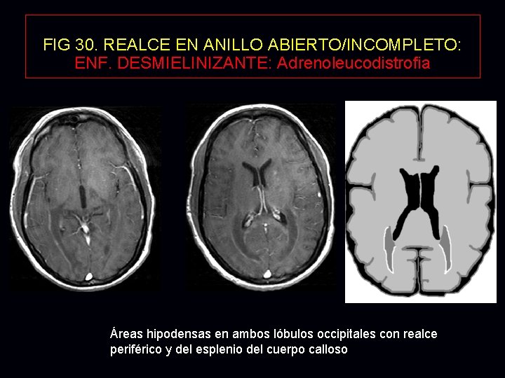 FIG 30. REALCE EN ANILLO ABIERTO/INCOMPLETO: ENF. DESMIELINIZANTE: Adrenoleucodistrofia Áreas hipodensas en ambos lóbulos