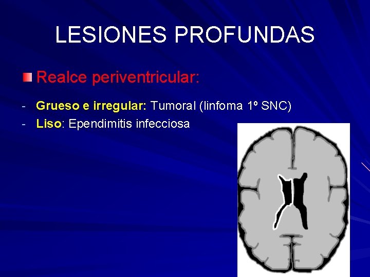 LESIONES PROFUNDAS Realce periventricular: - Grueso e irregular: Tumoral (linfoma 1º SNC) - Liso: