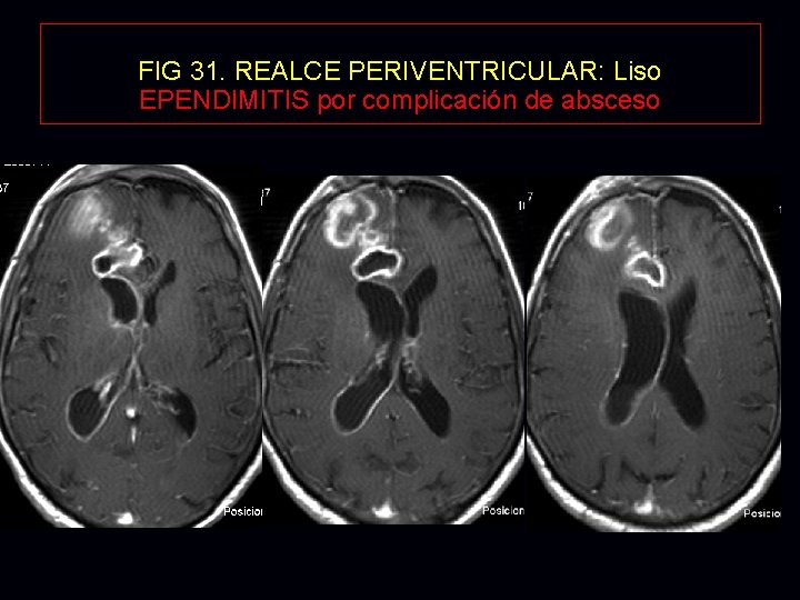 FIG 31. REALCE PERIVENTRICULAR: Liso EPENDIMITIS por complicación de absceso 