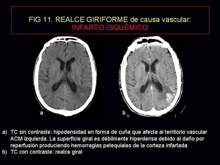 FIG 11. REALCE GIRIFORME de causa vascular: INFARTO ISQUÉMICO a b a) TC sin