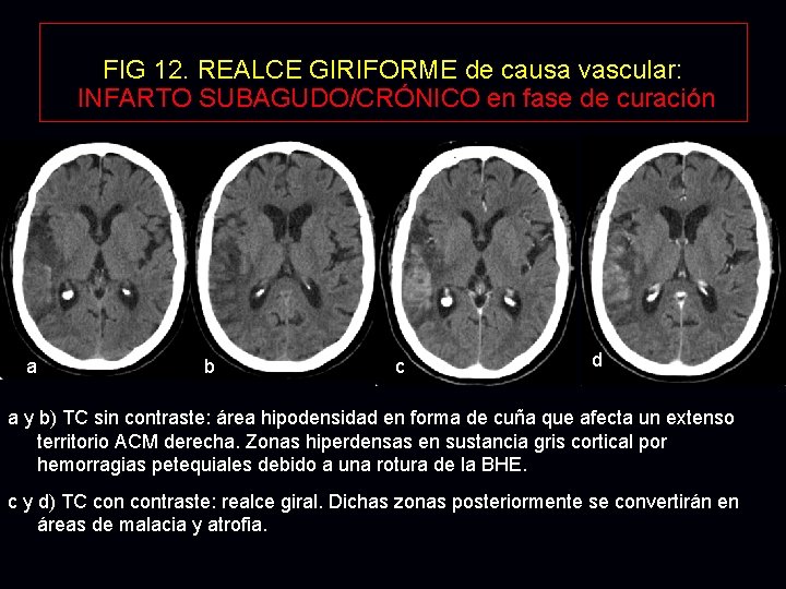 FIG 12. REALCE GIRIFORME de causa vascular: INFARTO SUBAGUDO/CRÓNICO en fase de curación a