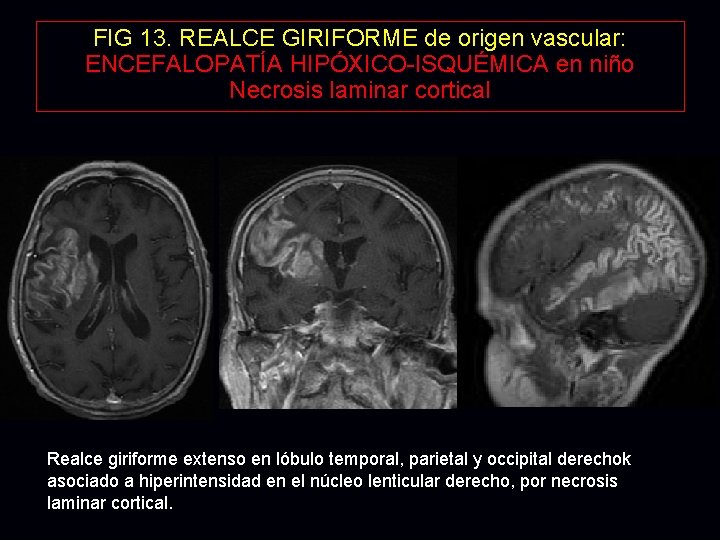 FIG 13. REALCE GIRIFORME de origen vascular: ENCEFALOPATÍA HIPÓXICO-ISQUÉMICA en niño Necrosis laminar cortical