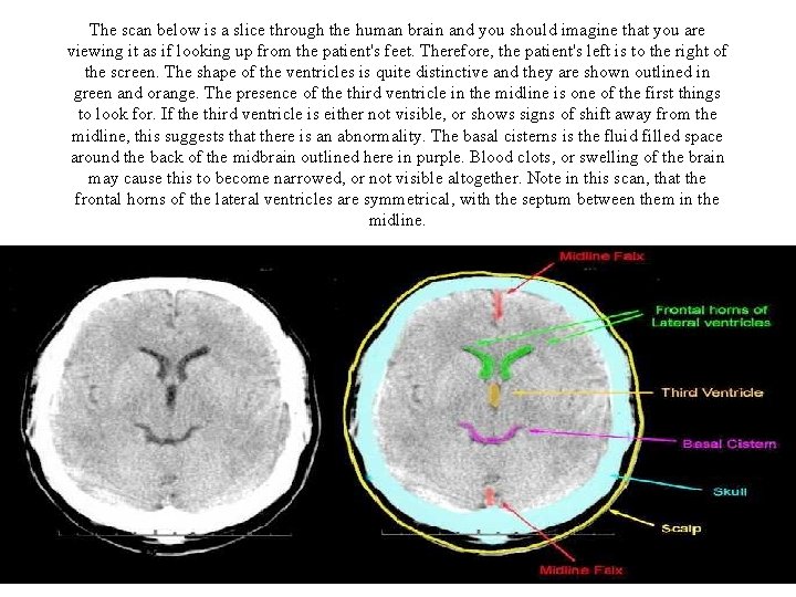 The scan below is a slice through the human brain and you should imagine