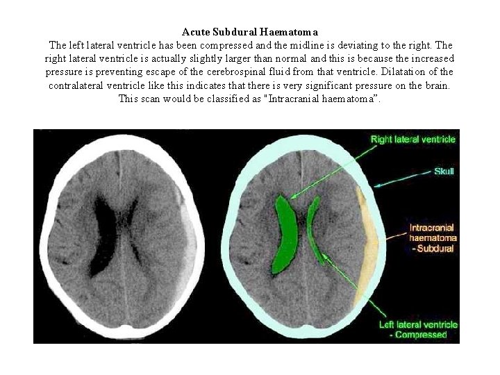 Acute Subdural Haematoma The left lateral ventricle has been compressed and the midline is